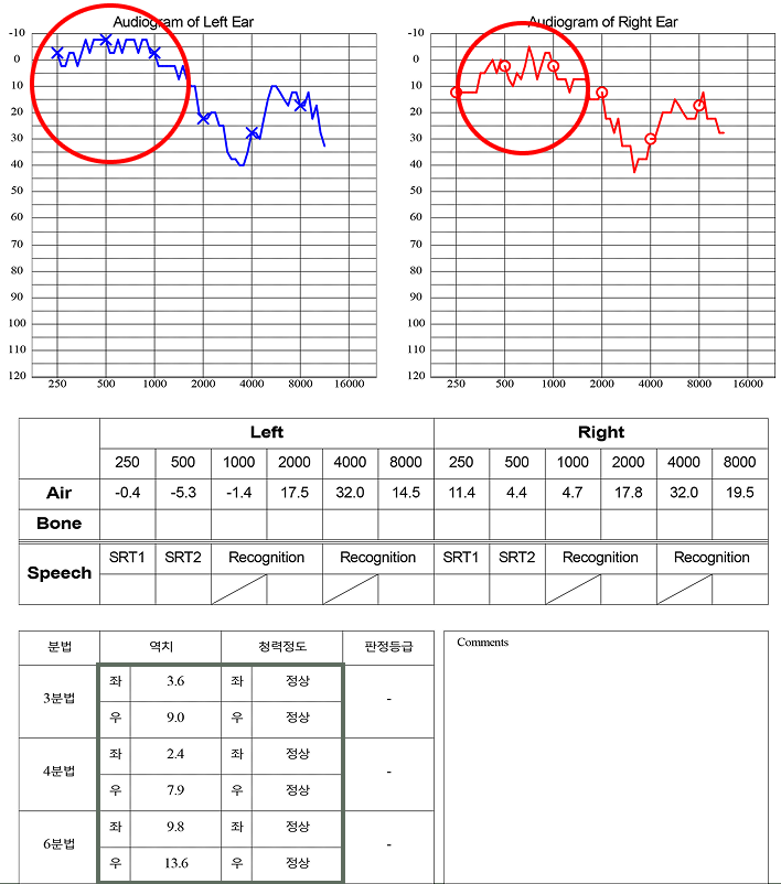 메니에르 치료 후 검사 결과
