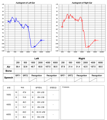 어지럼증 치료 전 검사 결과