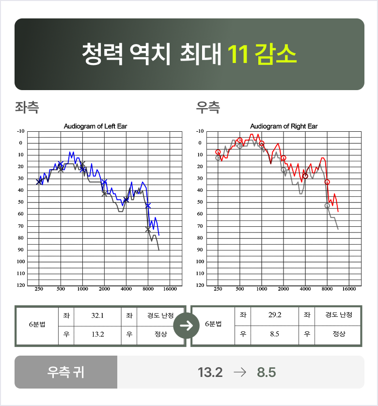청력 역치 최대 11 감소