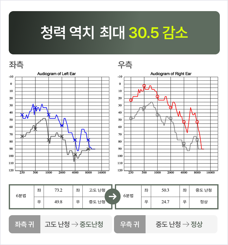 청력 역치 최대 30.5 감소