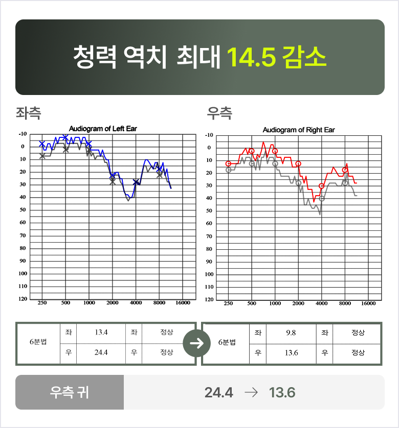 청원 이명 솔루션 1개월 후 변화 청력 역치 최대 14.5 감소