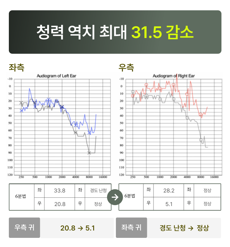 청원 이명 솔루션 6개월 후 변화  청력 역치 최대 31.5 감소