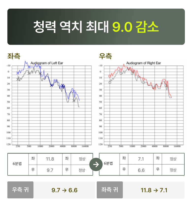 청원 이명 솔루션 3개월 후 변화  청력 역치 최대 9.0 감소