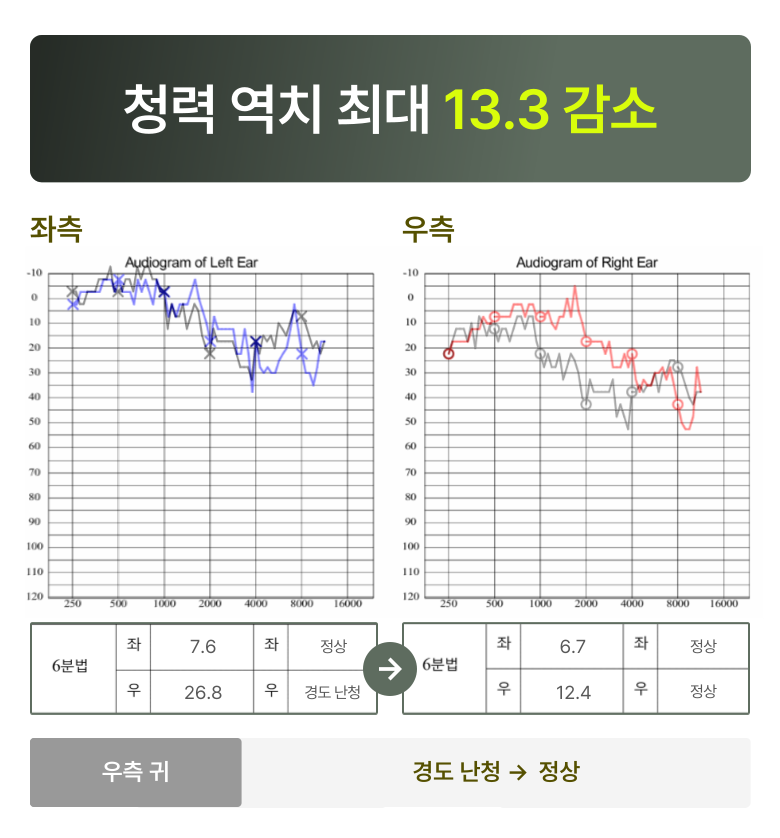 청원 이명 솔루션 5개월 후 변화  청력 역치 최대 13.3 감소