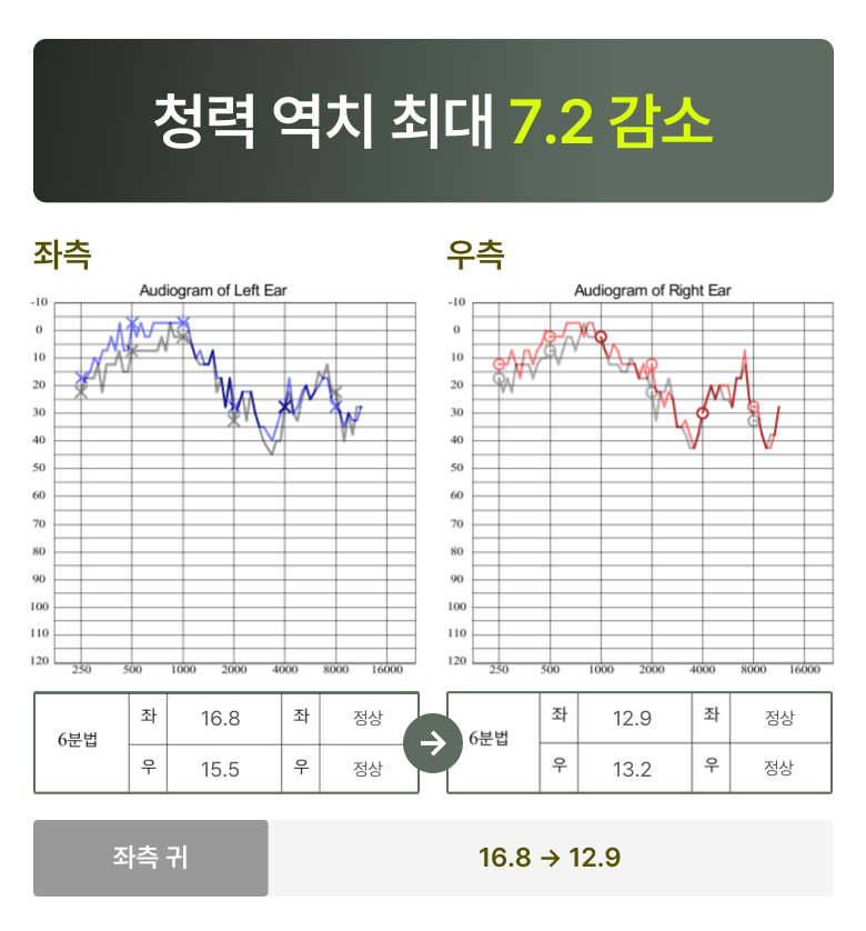청원 이명 솔루션 3개월 후 변화  청력 역치 최대 7.2 감소