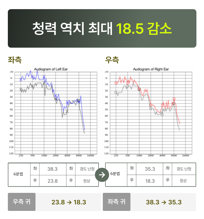청원 이명 솔루션 6개월 후 변화  청력 역치 최대 18.5 감소