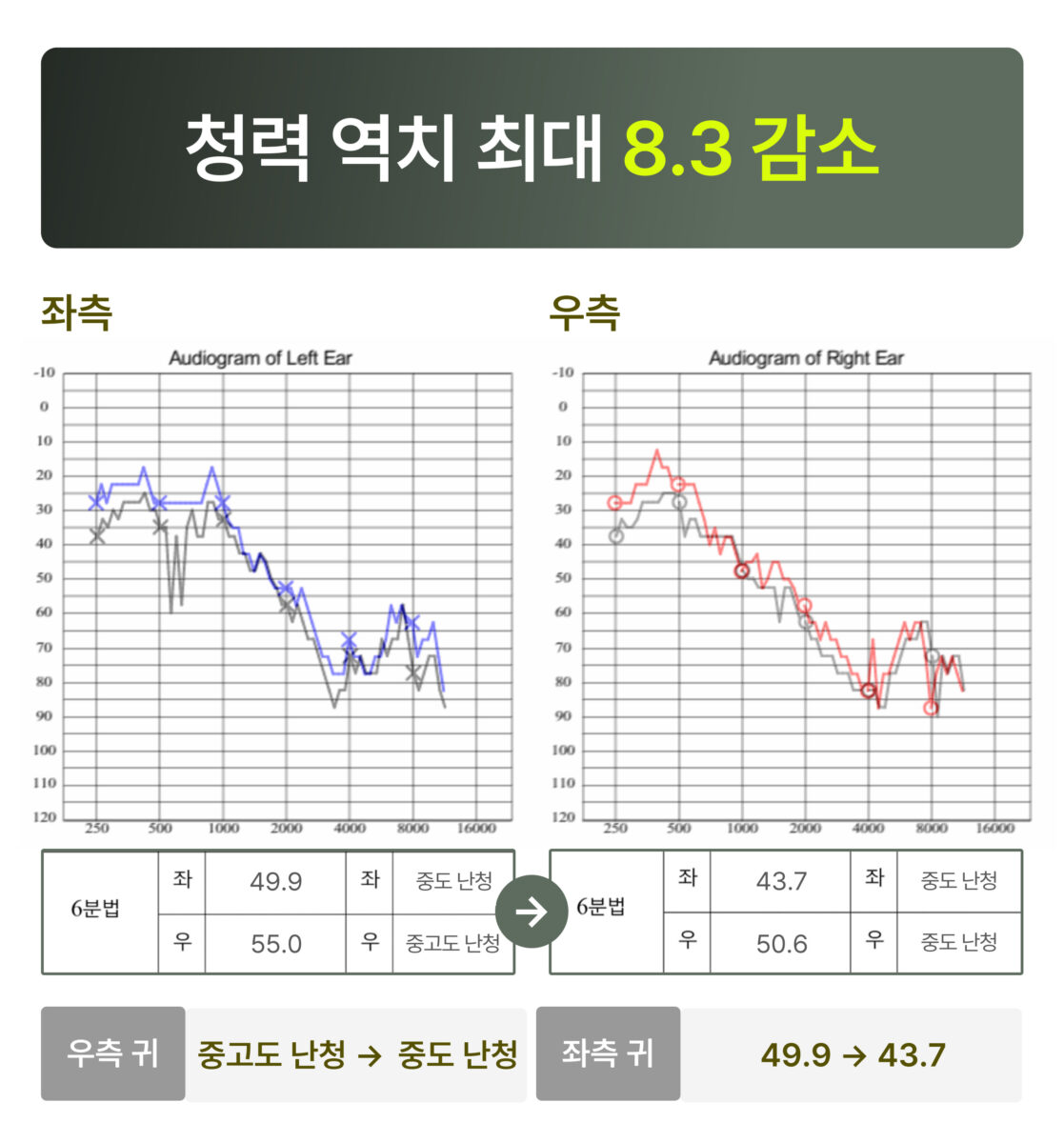 청원 이명 솔루션 4개월 후 변화  청력 역치 최대 8.3 감소