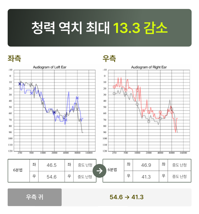 청원 이명 솔루션 3개월 후 변화  청력 역치 최대 13.3 감소