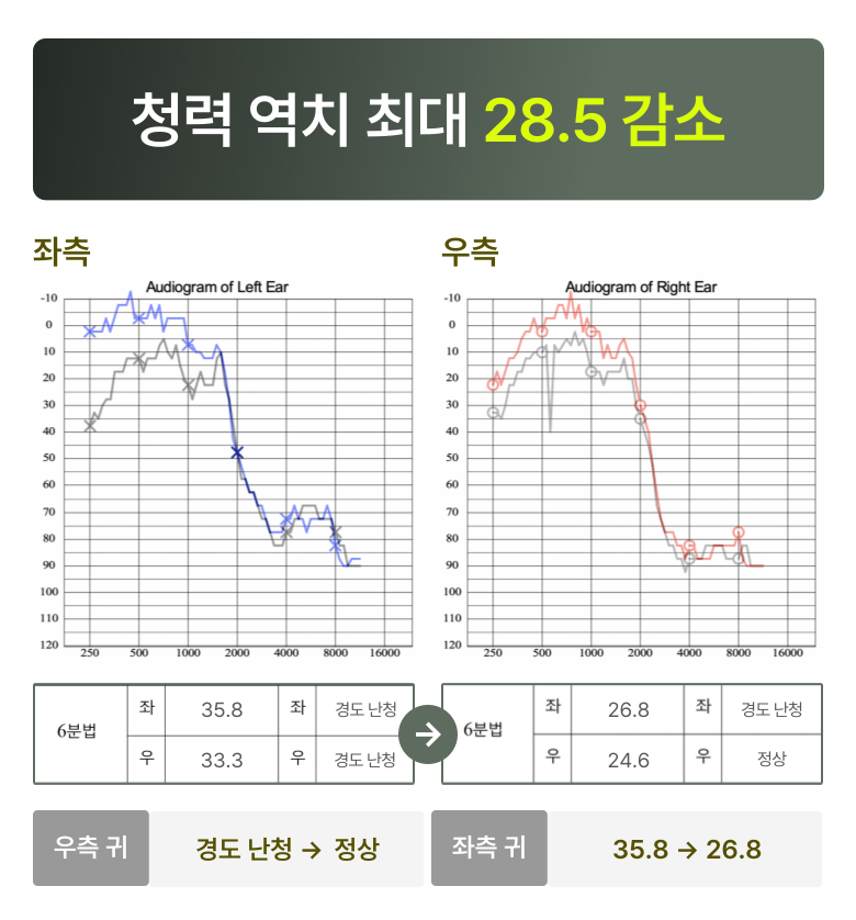 청원 이명 솔루션 5개월 후 변화  청력 역치 최대 28.5 감소