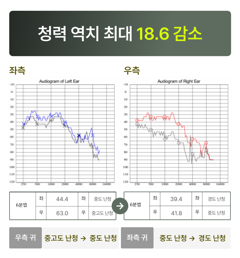 청원 이명 솔루션 3개월 후 변화  청력 역치 최대 18.6 감소